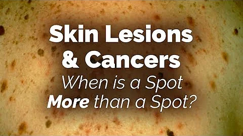When is a Spot More than a Spot? Skin Lesions and Cancers - DayDayNews