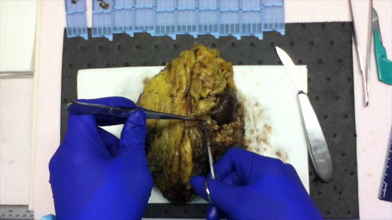 Radical Nephrectomy