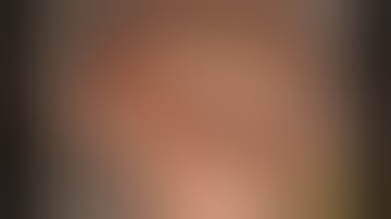 Eroded Incus - Total Ossicular Chain Reconstruction & Total TM Perforation - Total Flap Removal