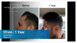 Norwood 4 Patient Looks and Feels 10 Years Younger! | Dr. Huebner (Efrain)