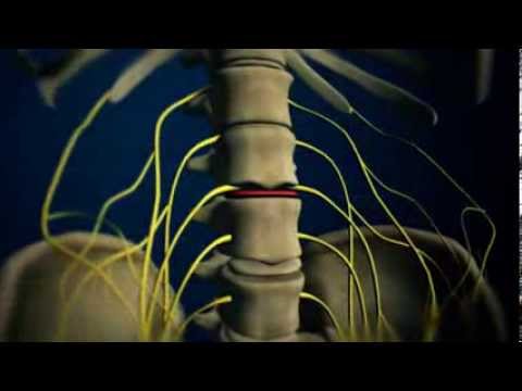 ხერხემალი, ნეიროქირურგია - მედარეა