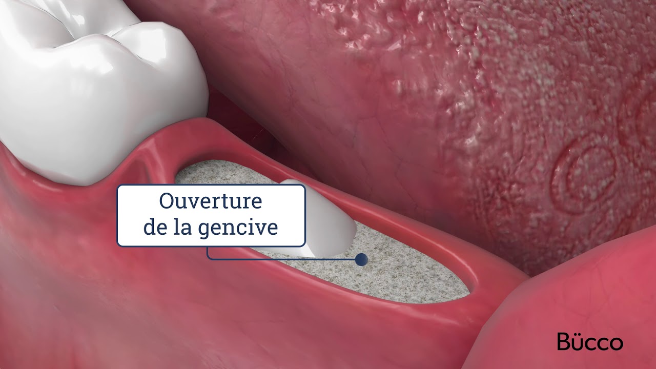 Extraction des dents de sagesse