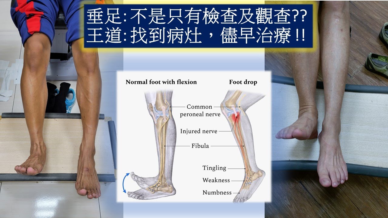 垂足，drop foot YouTube