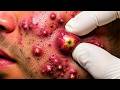 Feel The Extraction Through The Screen | Pimple Popping