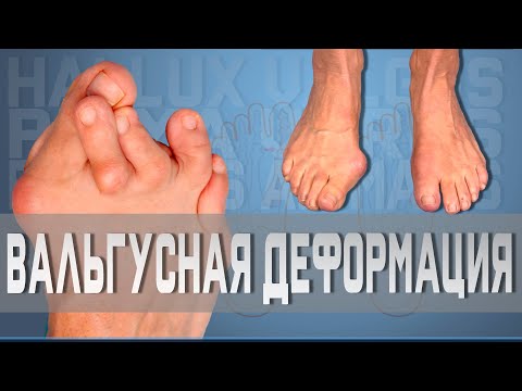 Вальгусная деформация большого пальца | Доктор Демченко