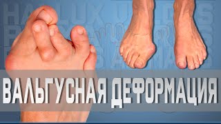 Вальгусная деформация большого пальца | Доктор Демченко