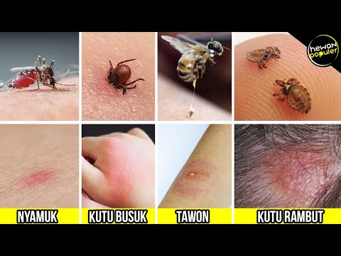 Video: Bintik Merah Di Kaki: Gigitan Serangga, Psoriasis, Punca Lain