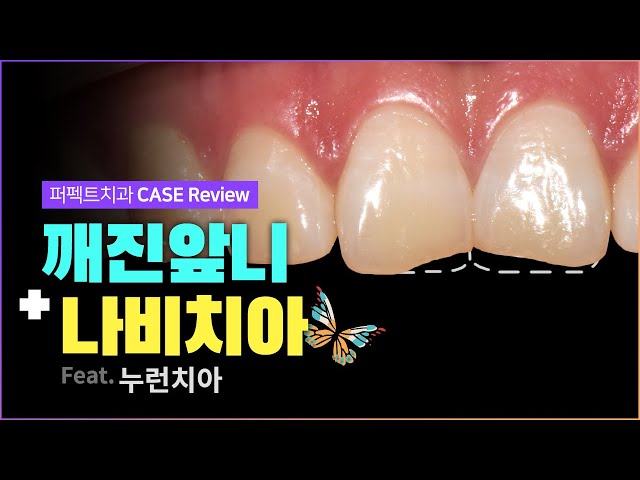 깨진앞니(치아파절) + 나비치아 | 최소삭제 라미네이트🦷