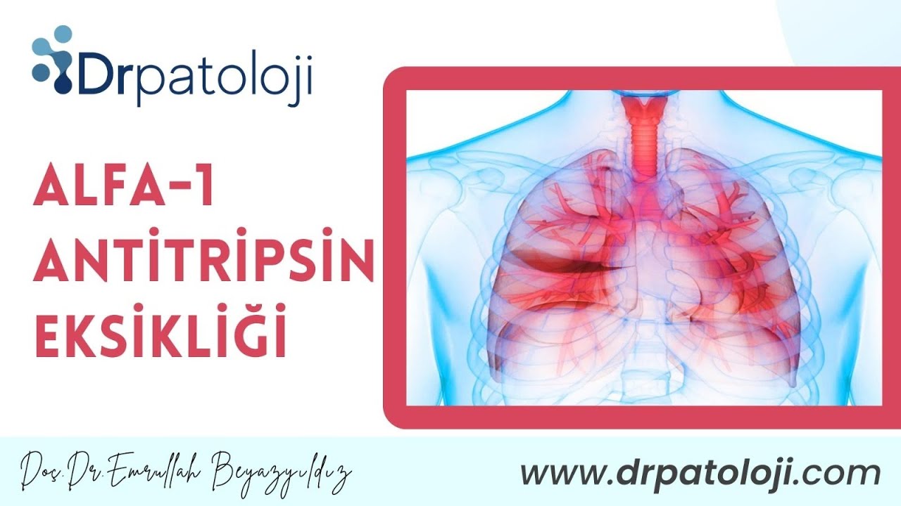 Alfa 1 Antitripsin Eksikliği