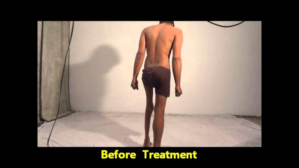 Review of a Post Polio Deformity Corrected patient treated with HEXAPOD and Ilizarov