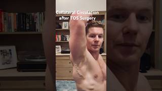 Collateral Blood Flow after my vTOS surgery! #tos #thoracicoutletsyndrome #humanbody