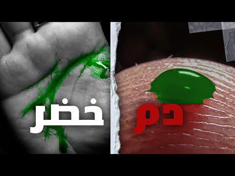 تحول لون الدم إلى اللون الأخضر