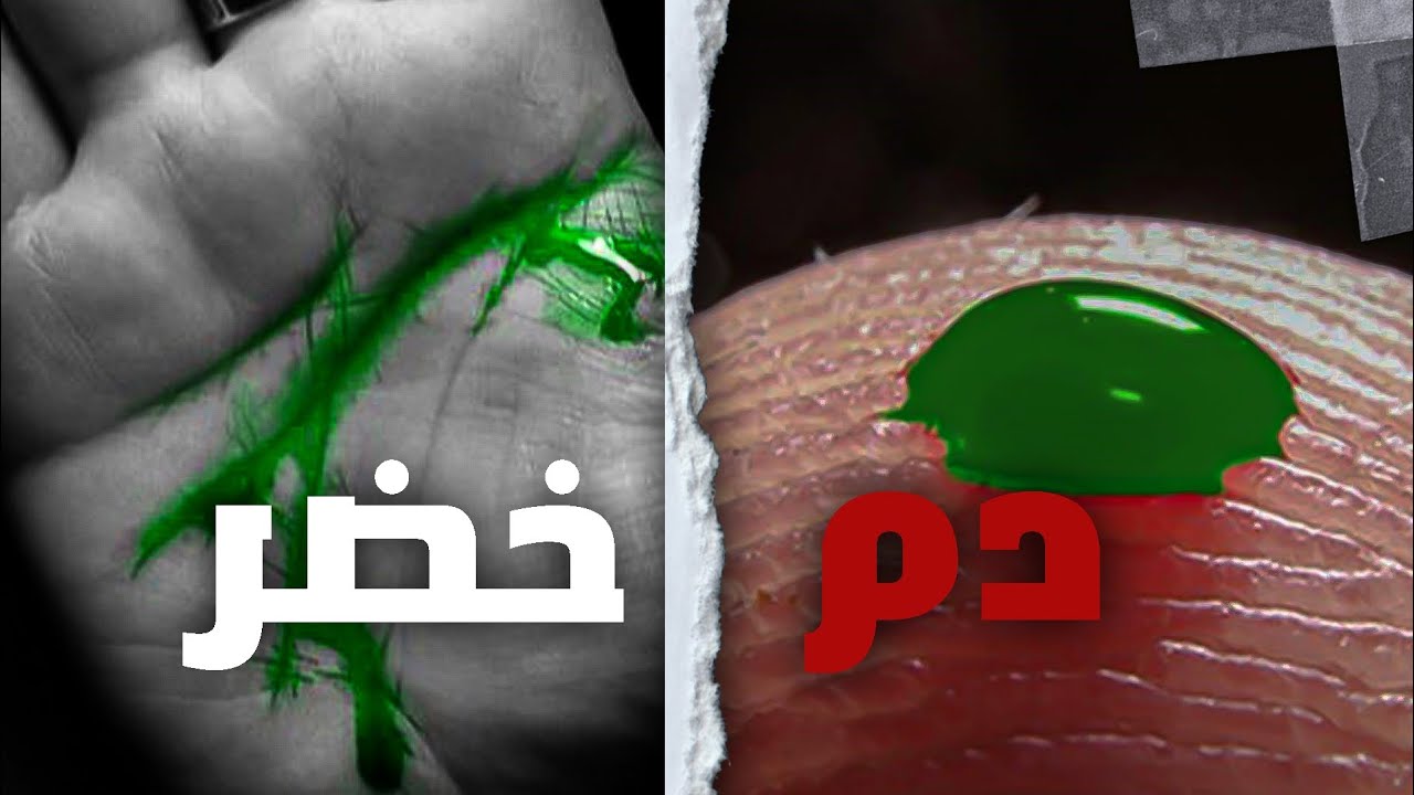 تحول🧬 لون الدم إلى اللون الأخضر 🧪