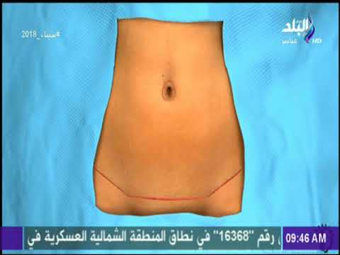انتفاخ البطن بعد عملية شفط الدهون