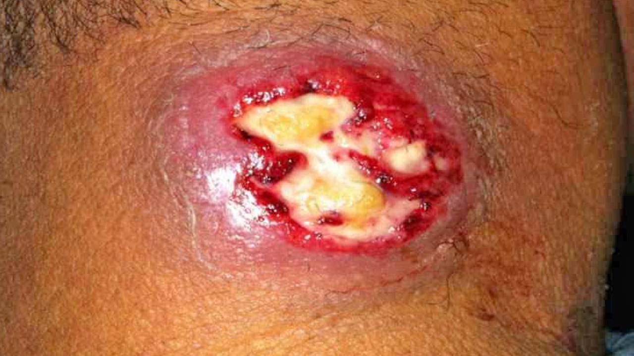 Staph Infection Symptoms, Causes, Pictures & Treatment