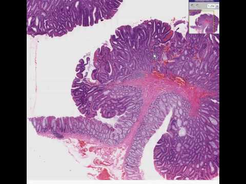 what are tubular polyps