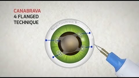 4-Flanged 5.0 prolene Suture Technique with Akreos IOL