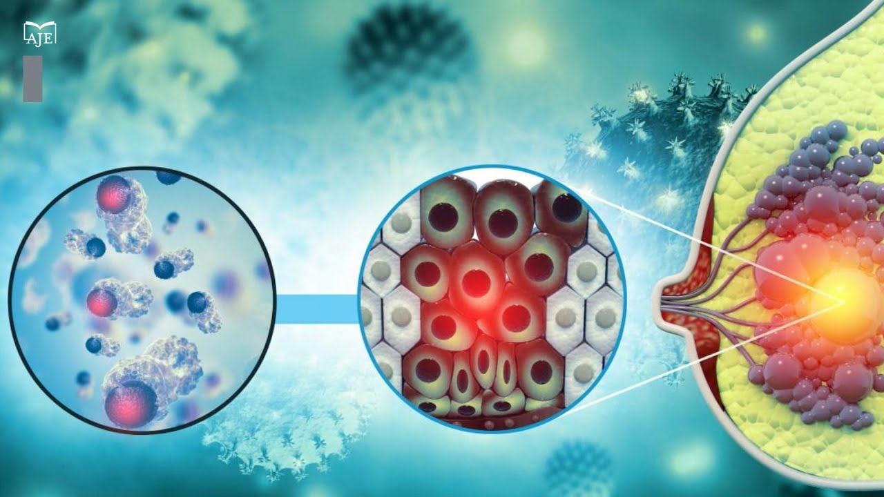 P53 Loss Drives Breast Cancer to the Brain Through Fatty Acid Addiction