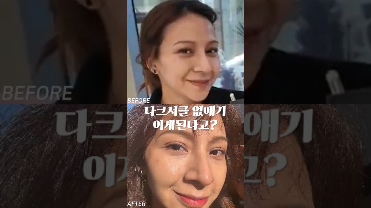[Beauty Blossom Clinic] Giải quyết quầng thâm với Eye Rejuran! #BeautyBlossomClinic #BeautyBlossom #QuầngThâmMắt #beautyblossom #darkcircles #rejuran #rejuran #trehoamat
