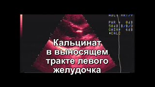 Кальцинат В Выносящем Тракте Левого Желудочка, Редкое Наблюдение.