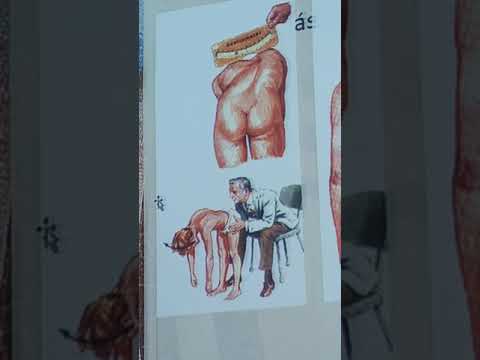 Videó: 3. Fokozatú Scoliosis - Jellemzők, Tünetek és Kezelés