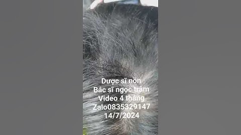 rụng tóc mảng. bé khang vĩ. video 4 tháng kết thúc liệu trình #hair