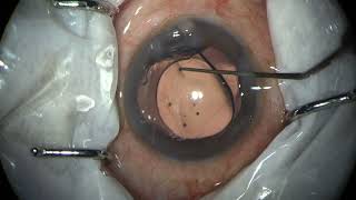 CORTICAL CLEAVING HYDRODISSECTION – A FORGOTTEN ART