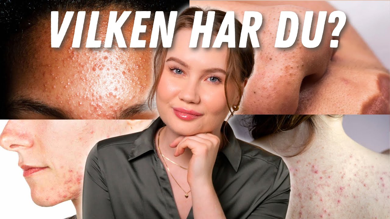 Olika typer av Akne & HUR du blir av med dem