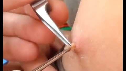 botfly larvae removal