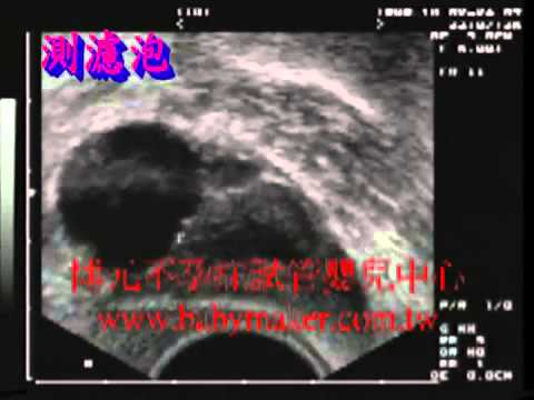 博元基因晶片試管嬰兒