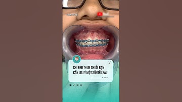 Những lưu ý khi đeo thun chuỗi  #nhakhoa #niengrang #nhatkyniengrang #viral