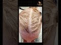 Best Hair Transplant for Women at Adajan, Surat  Female Hair Loss Treatment Hair Restoration Experts