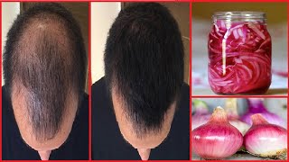 Onion Hair Gel : 15 दिनों में प्याज के रस से बालों को Regrowth करे | Onion Gel For Hair Growth