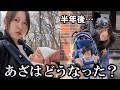 【生後８ヶ月】顔あざのその後…半年ぶりに再受診しました。
