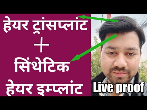 Real Secret Of My Hair Transplant results In India || Hair Transplant + Synthetic Hair Ya Hair