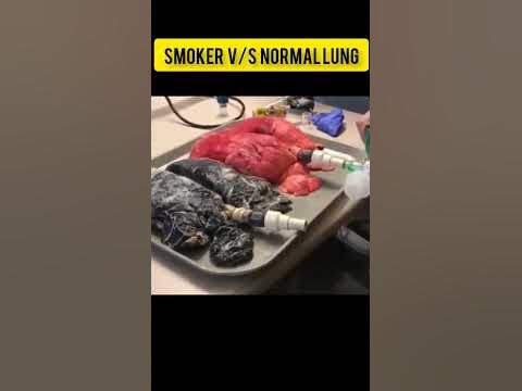 smoker-vs-normal-lung-mbbs-neet-neet2023