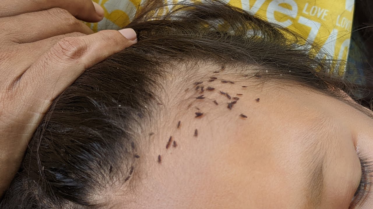 Head Lice  Walkin Dermatology