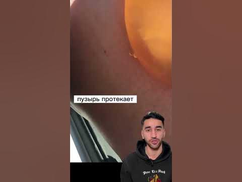 ожоговый пузырь - YouTube