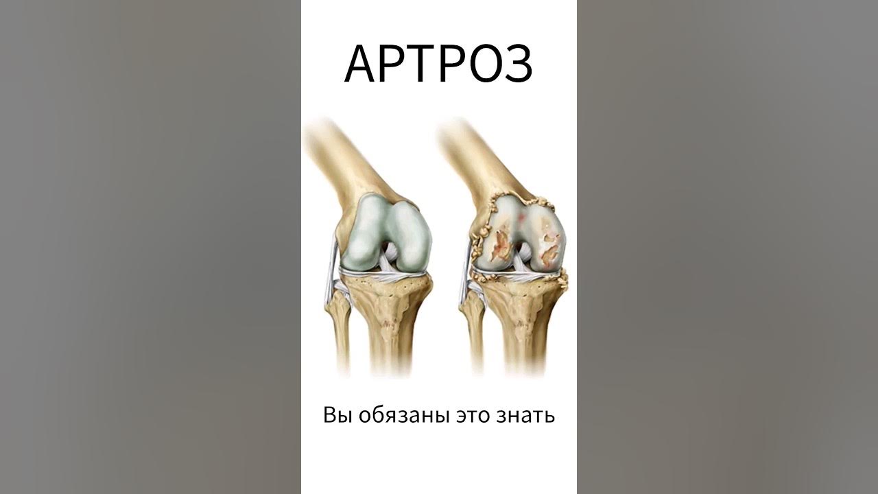 Лучшее лекарство при артрозе - YouTube