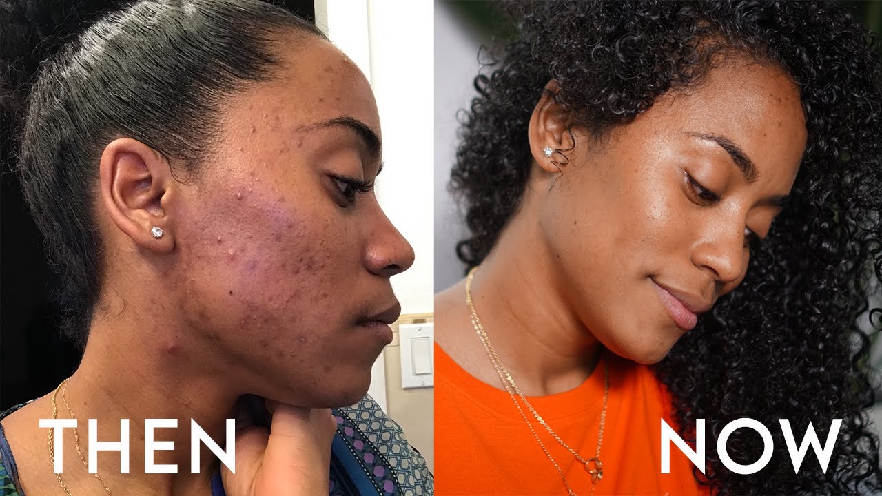 Goodbye Acne! Hello Face Reality Skincare One Year Update! YouTube