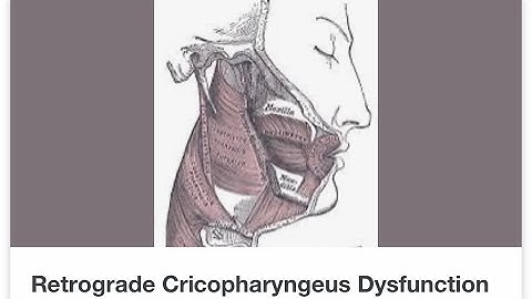 Part 1 of my RCPD journey (Retrograde Cricopharyngeus Dysfunction)