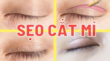 Cắt mí mắt bao lâu thì hết sẹo | Bác sĩ Trọng