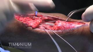 Achilles tendon repair