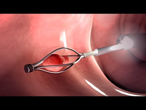 [yjzvisuals.com] 3D Medical Animation - Colonoscopy Procedure