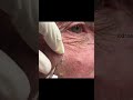 Blackheads or Sebaceous Filaments!
