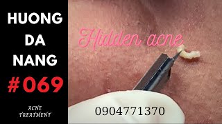 069 | So many hidden acne today | Hương Đà Nẵng - YouTube