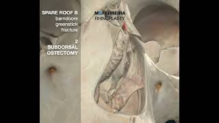 SPARE ROOF TECHNIQUE B -  SUBDORSAL OSTEOTOMY