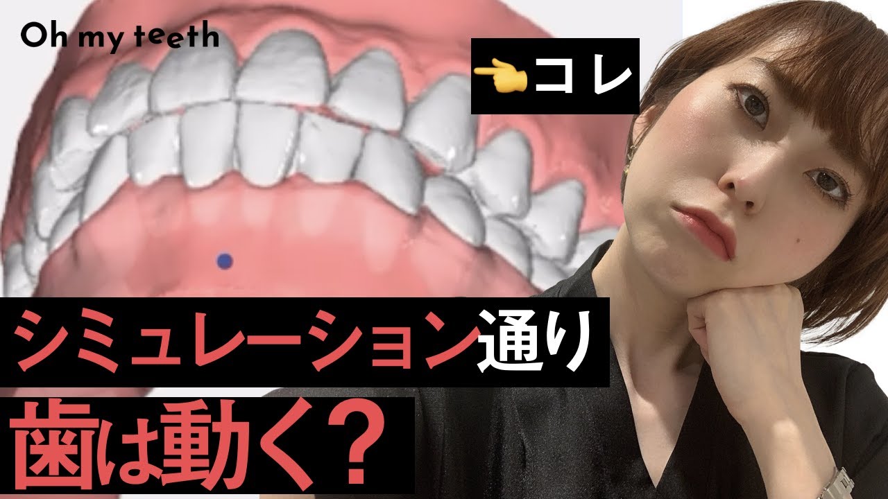マウスピース矯正 本当にシミュレーション通りに歯が動くのか？経過の