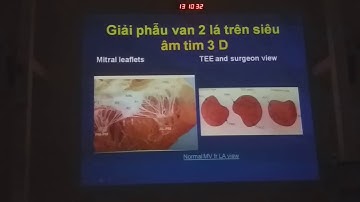 SIÊU ÂM TIM TRONG HỞ VAN 2 LÁ | TS. BS. NGUYỄN TUẤN VŨ