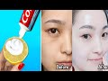 Apply Toothpaste on Your Skin and See Magical Result within 1 Hour ¦Amazing Toothpaste Beauty Hacks